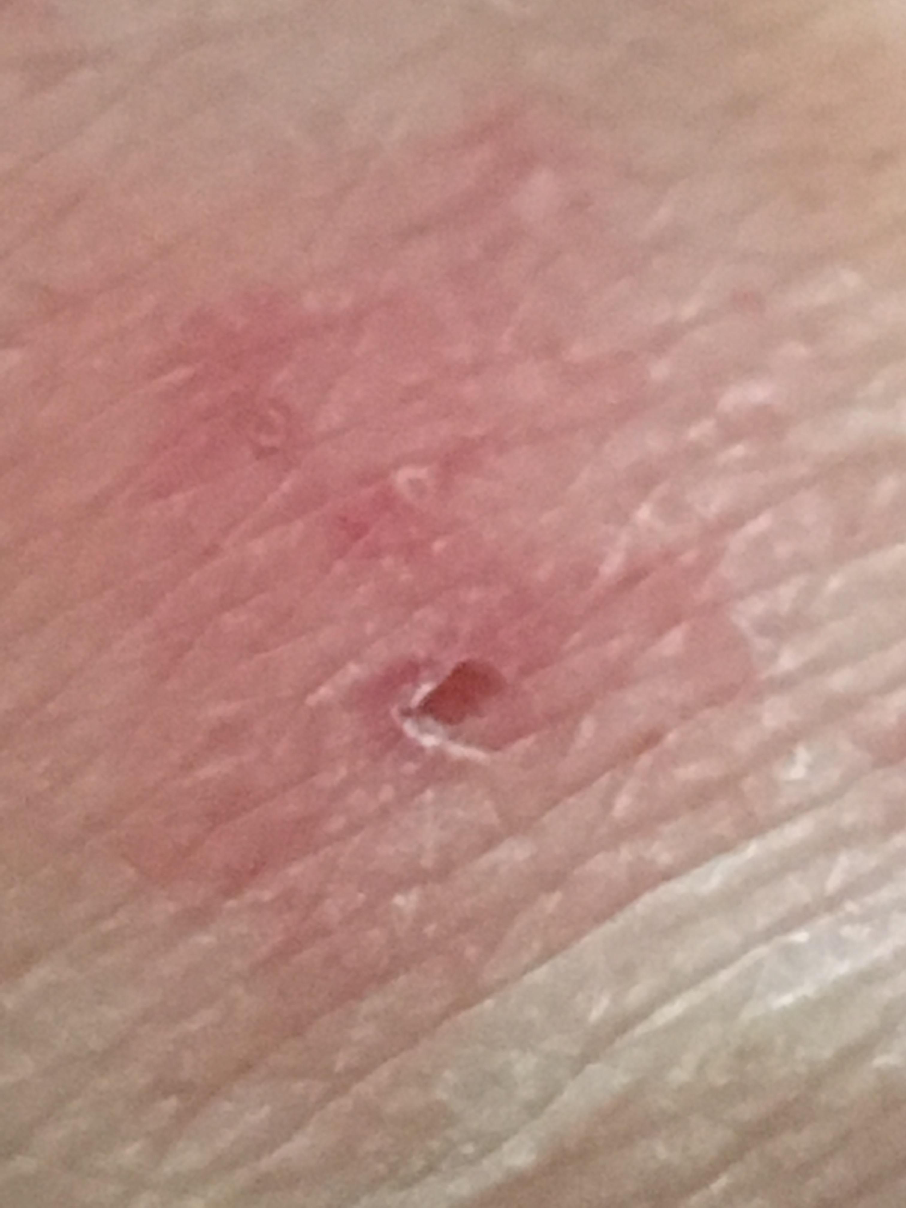 Help! Bug bite I’d needed - General Discussion - Neowin